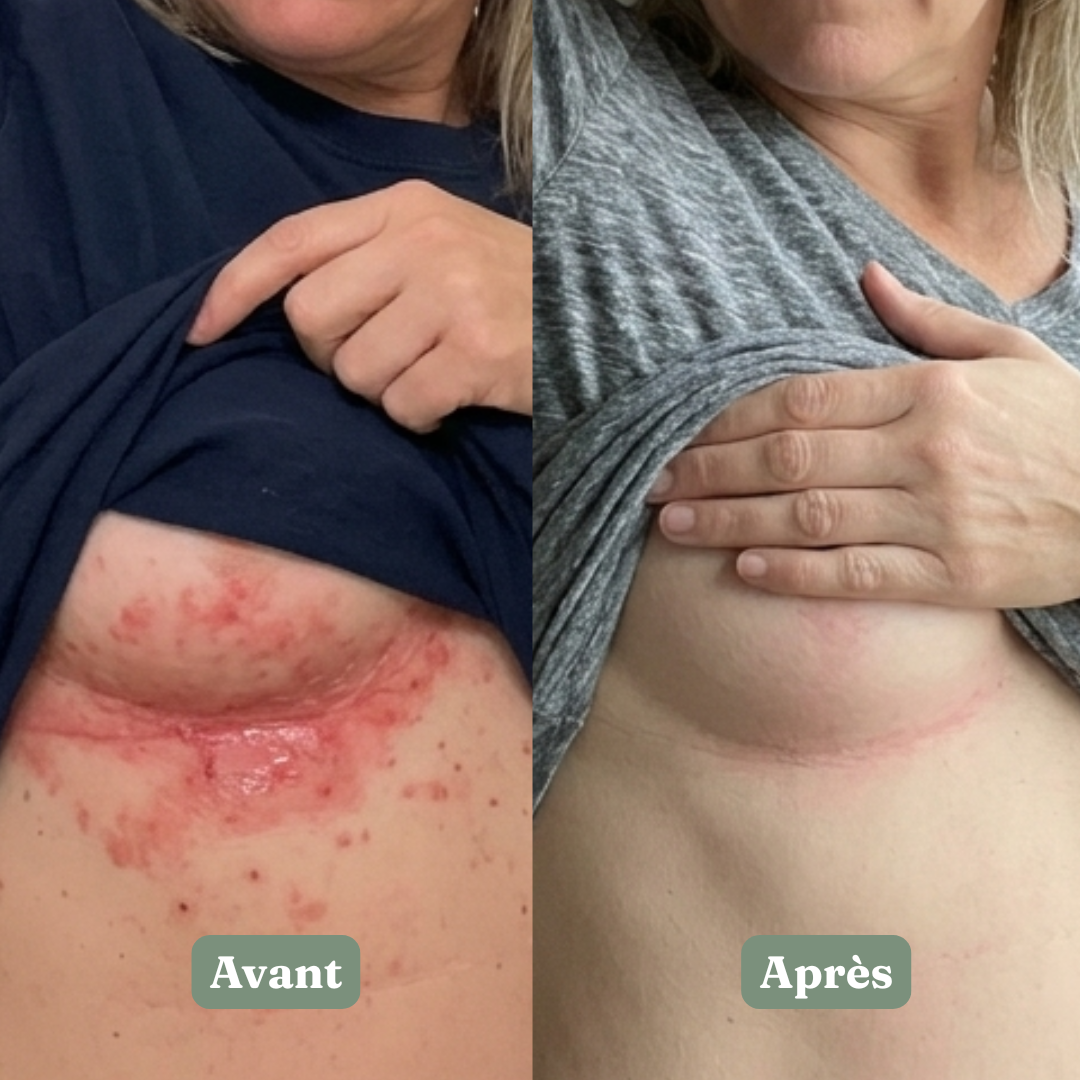 Nué® — Le premier savon spécifiquement conçu pour le pli sous la poitrine.