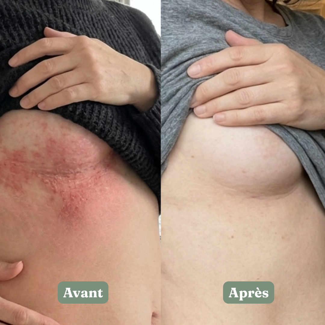 Nué® — Le premier savon spécifiquement conçu pour le pli sous la poitrine.